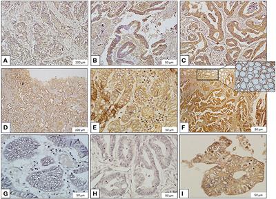 Evaluation of Galanin Expression in Colorectal Cancer: An Immunohistochemical and Transcriptomic Study